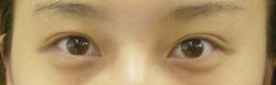 Double Eyelids